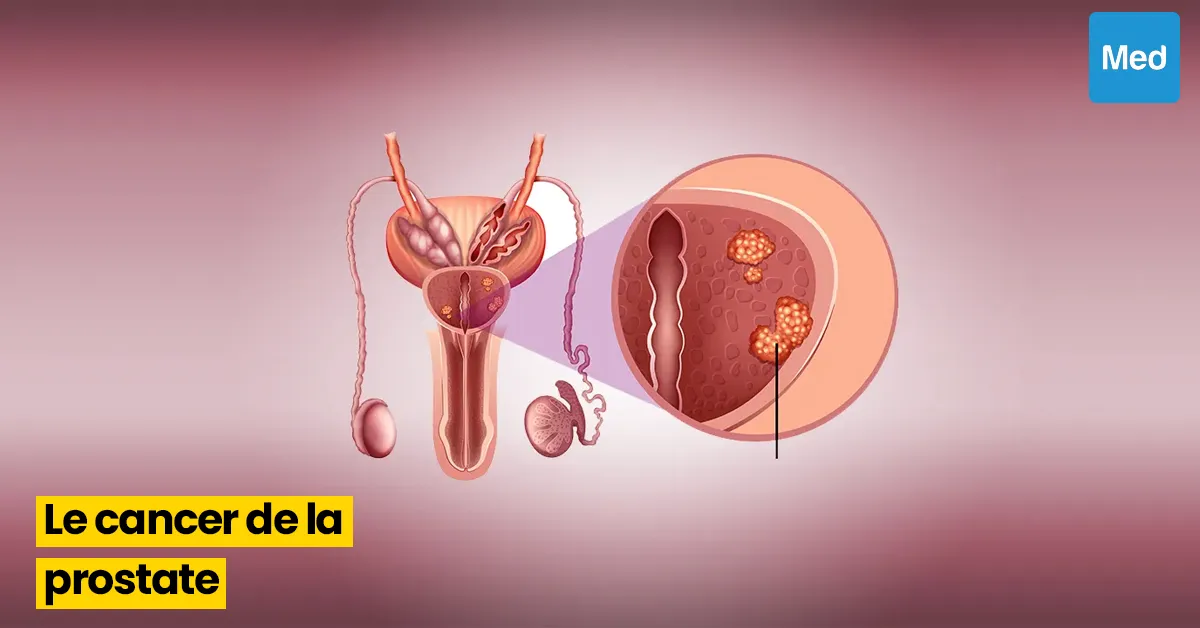 Le cancer de la prostate